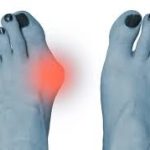 Bunion Deformity與拇趾外翻:香港市民必須關注的足部健康