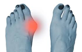 Bunion Deformity與拇趾外翻:香港市民必須關注的足部健康